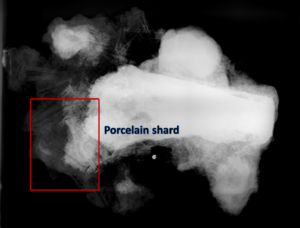 Porcelain shard in x-ray