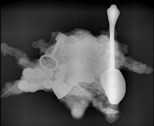 X-ray of concretion